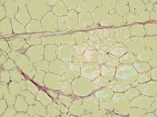 tejido adiposo blanco tejido adiposo blanco